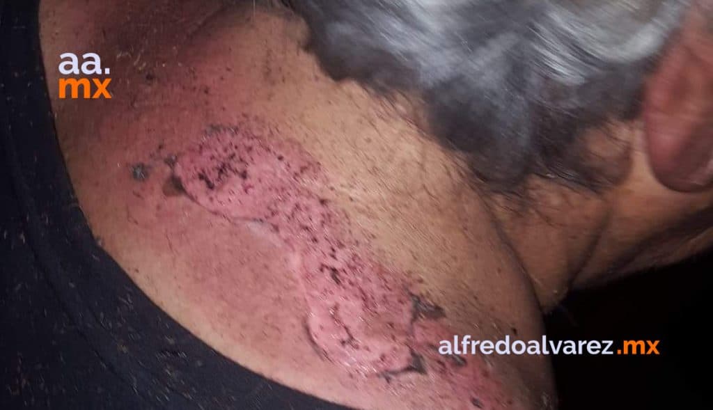 ABUELITOS HERIDOS TRAS INCENDIO DE SU VIVIENDA