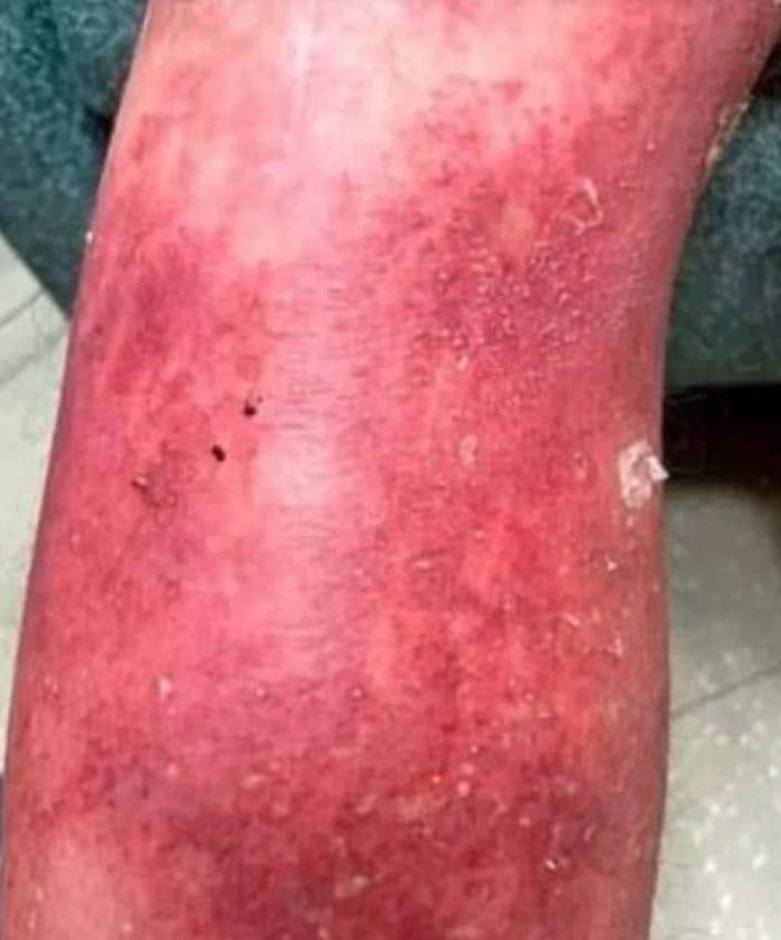 FOTO: SUFRE RARA ERUPCIóN EN LA PIEL TRAS RECIBIR VACUNA CONTRA COVID-19