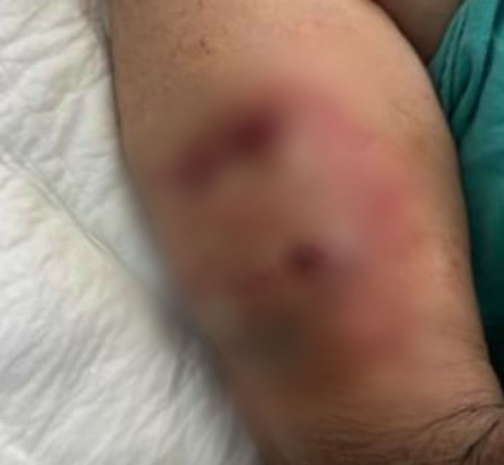 PERROS ATACAN A ADULTA MAYOR Y LE DESPRENDEN EL CUERO CABELLUDO